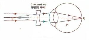 Concave lens- ENI
